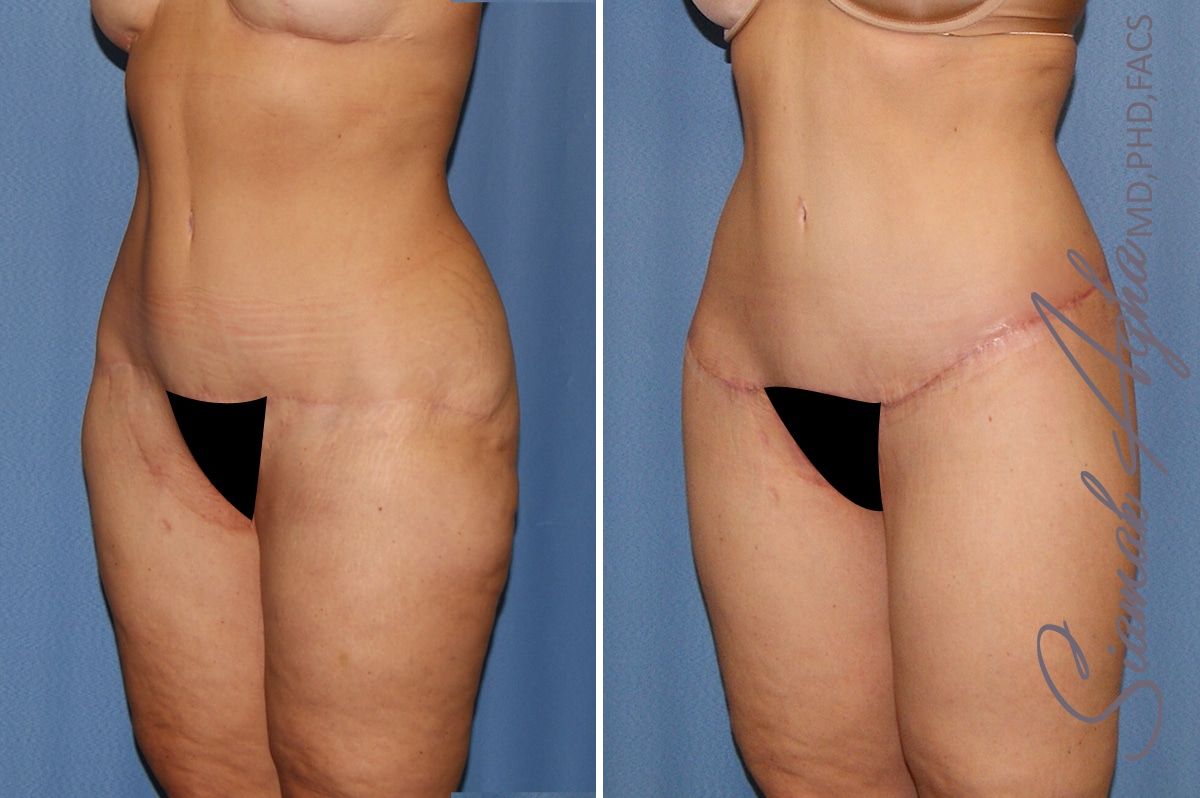 Lower Body Lift Before & After