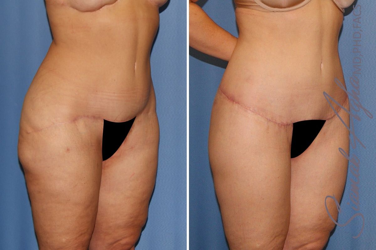 Lower Body Lift Before & After