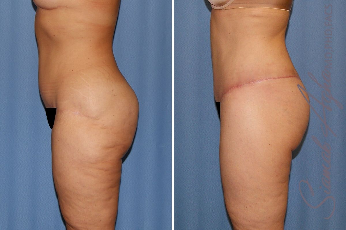 Lower Body Lift Before & After