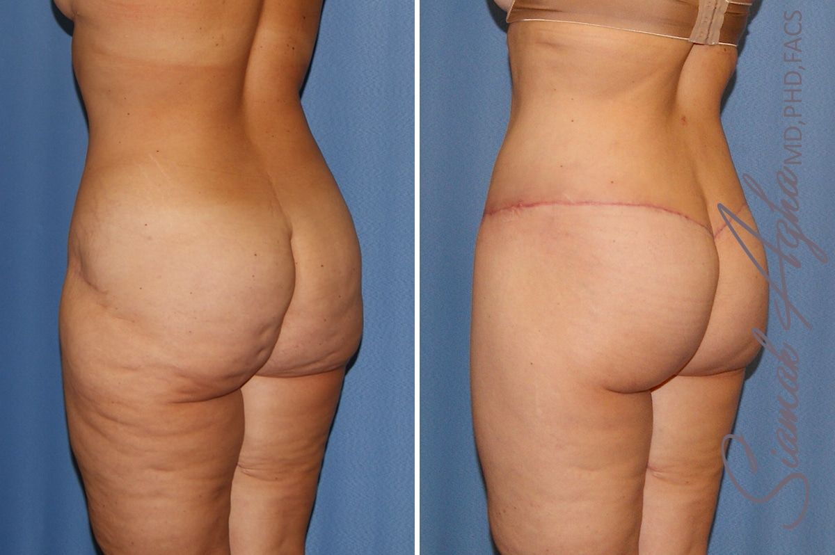 Lower Body Lift Before & After