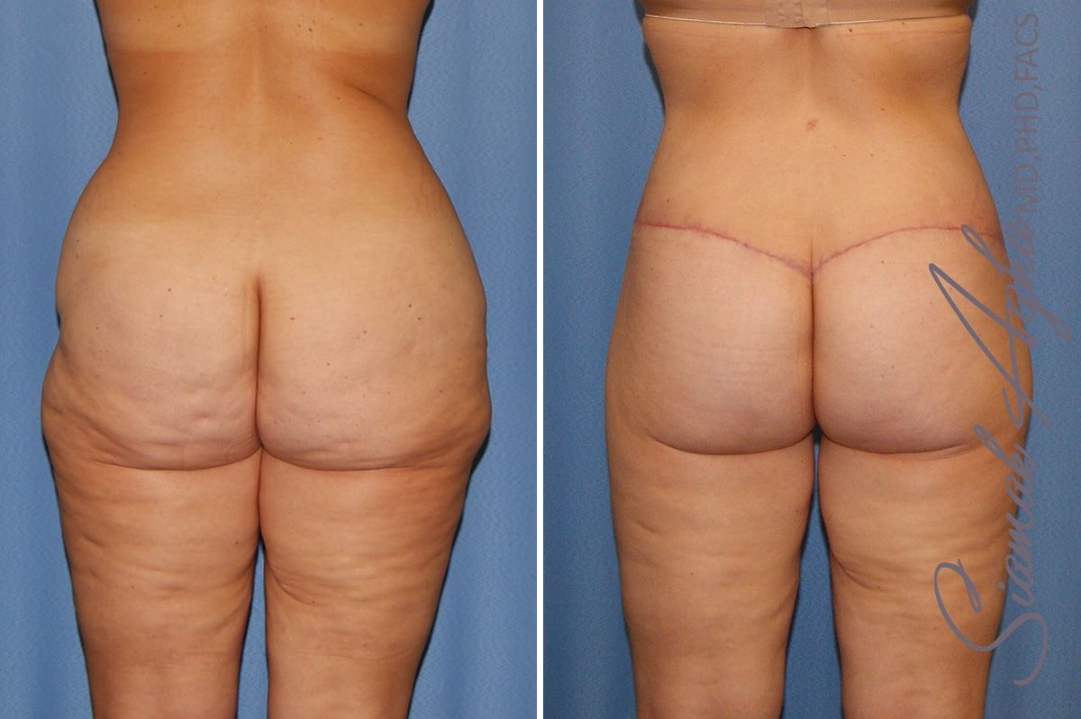 Lower Body Lift Before & After