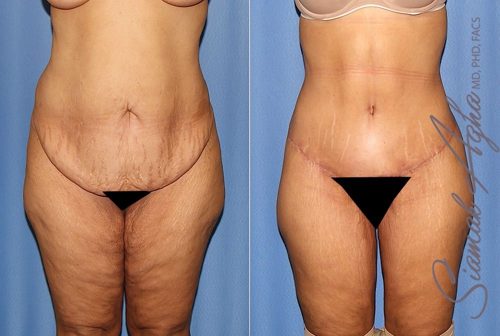 Lower Body Lift Before & After