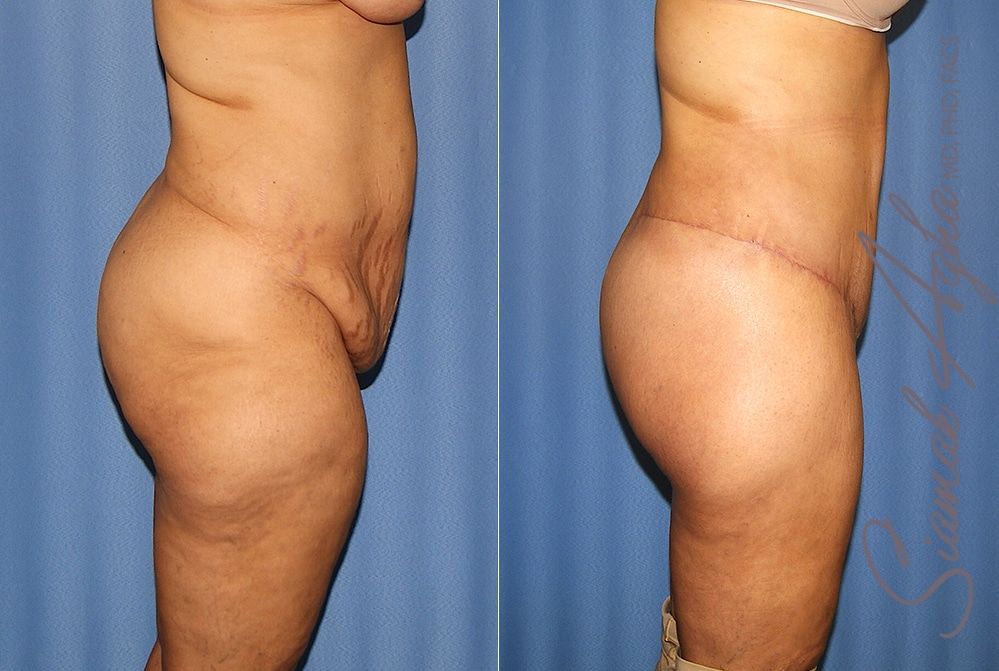 Lower Body Lift Before & After