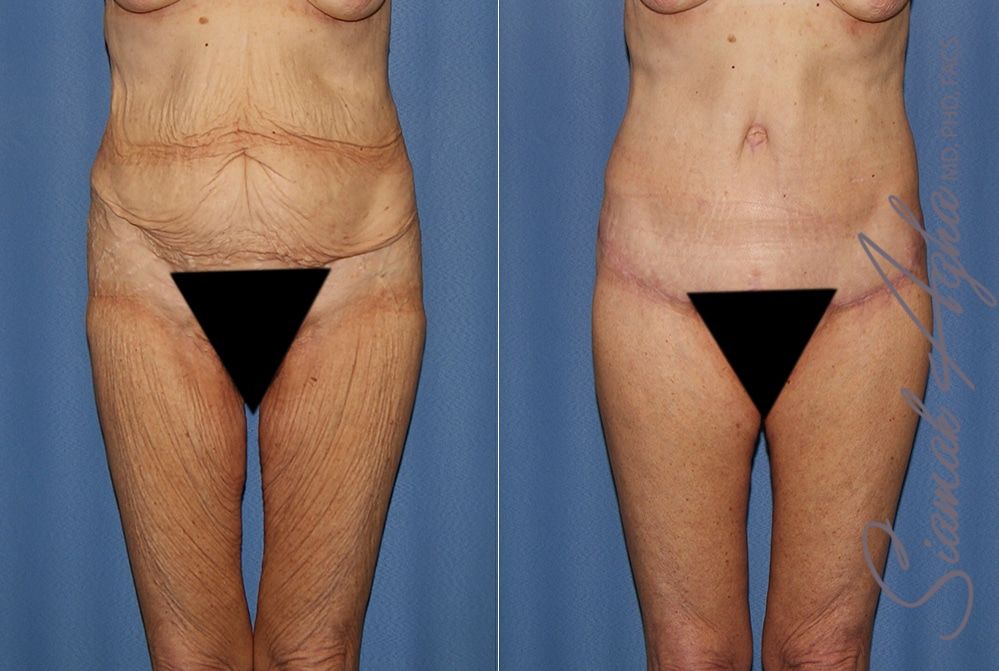 Lower Body Lift Before & After