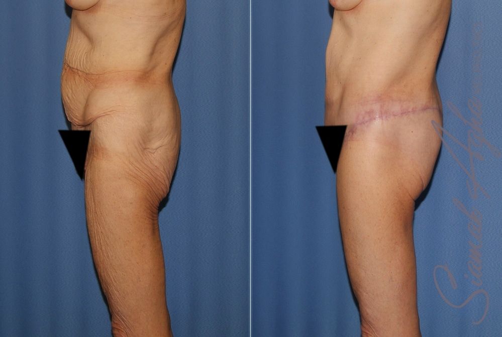 Lower Body Lift Before & After