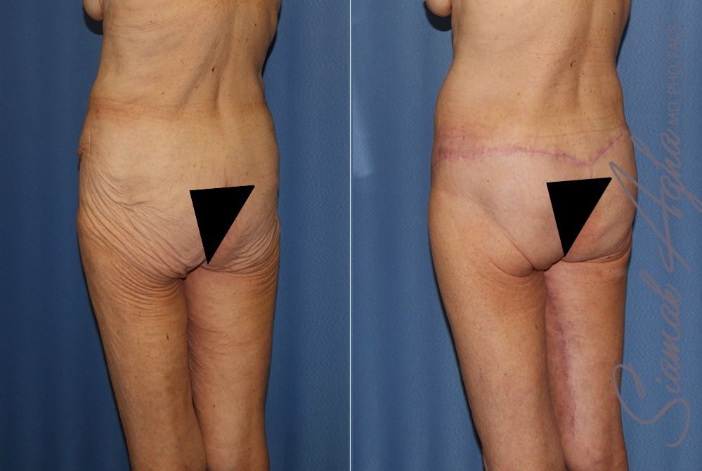 Lower Body Lift Before & After