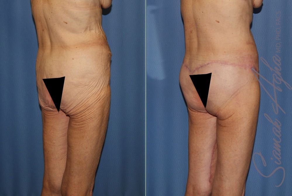 Lower Body Lift Before & After