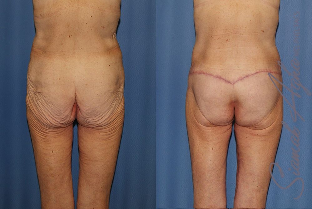 Lower Body Lift Before & After