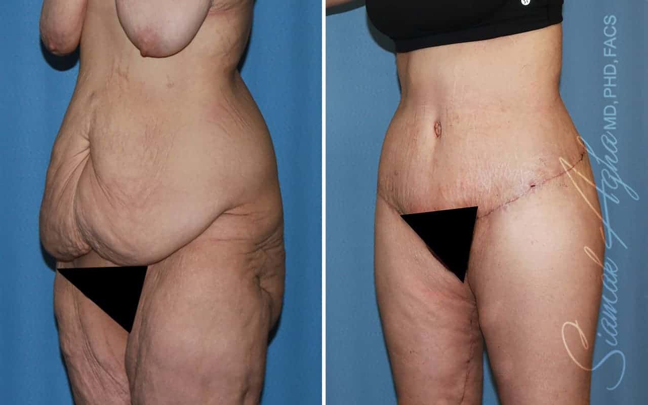 Lower Body Lift Before & After