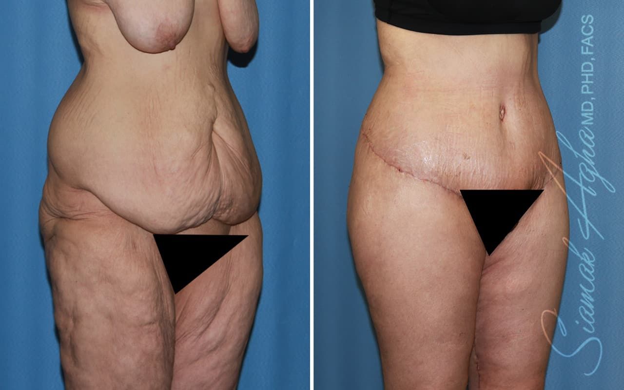 Lower Body Lift Before & After