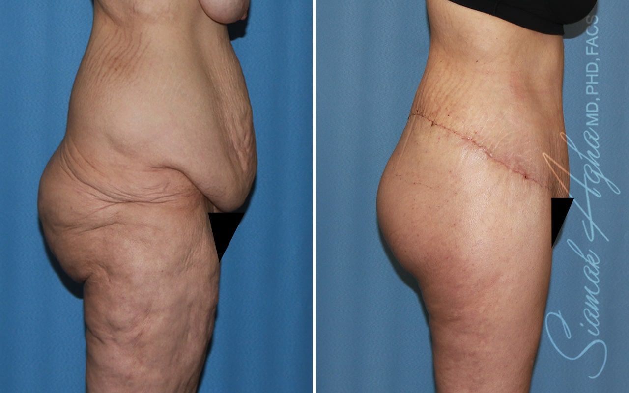 Lower Body Lift Before & After