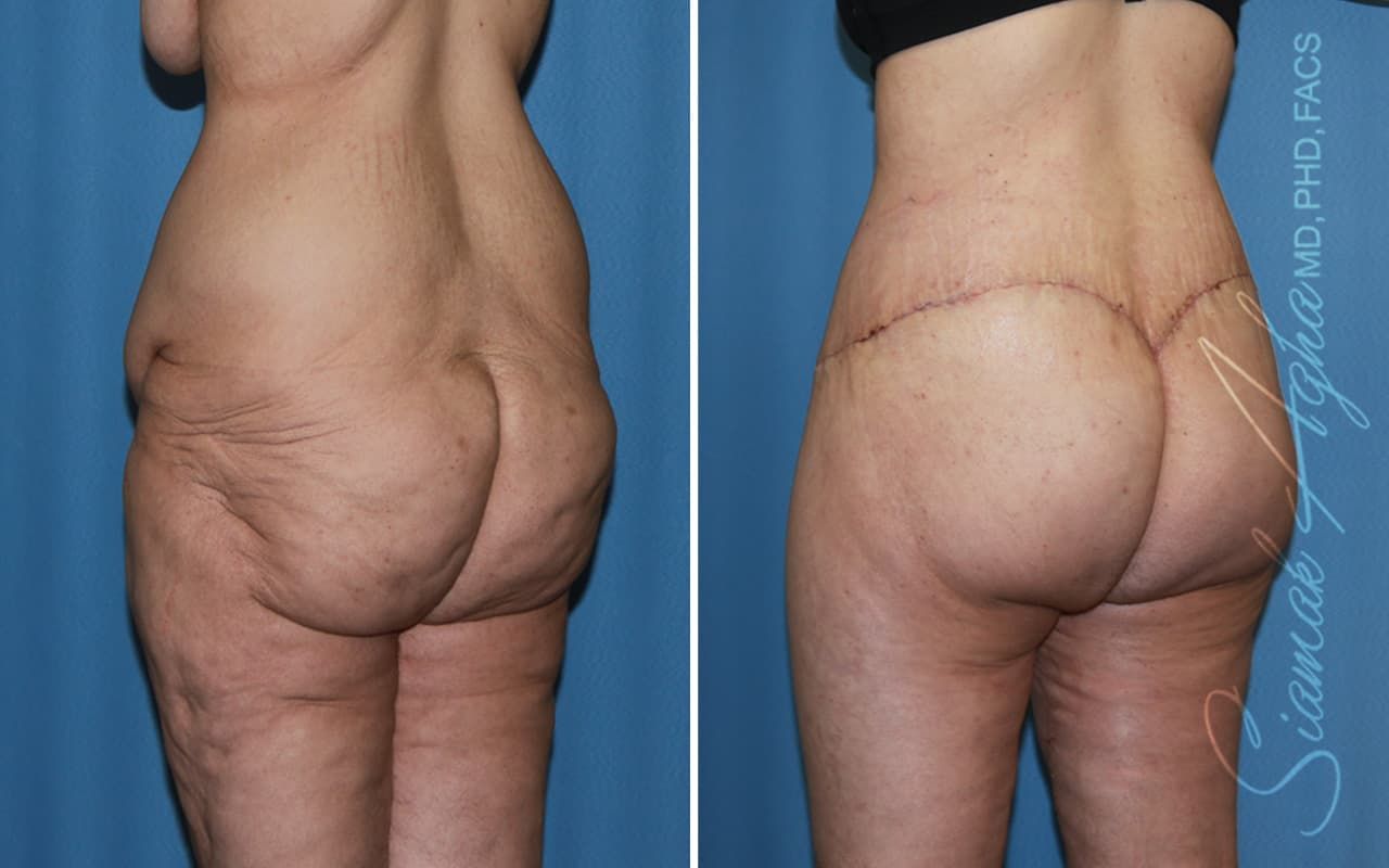 Lower Body Lift Before & After