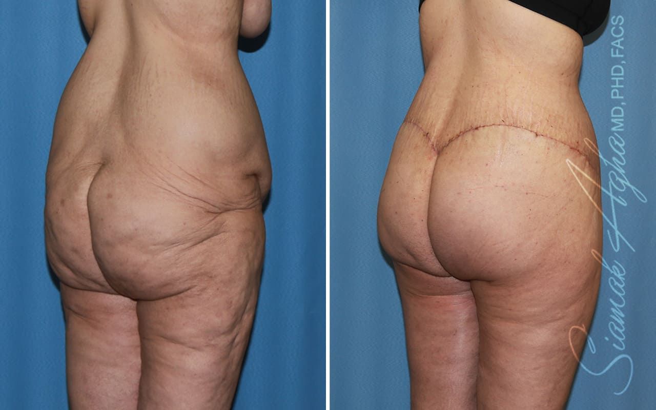 Lower Body Lift Before & After