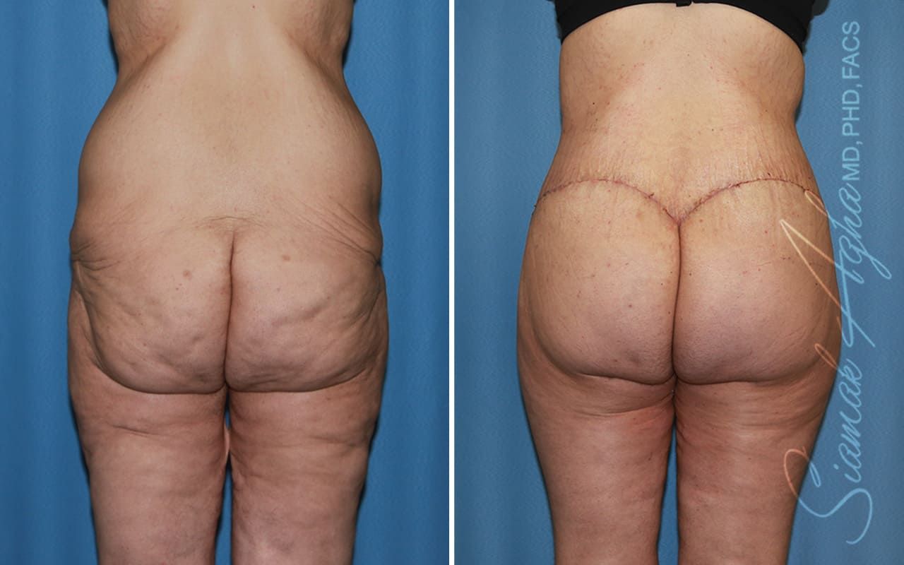 Lower Body Lift Before & After