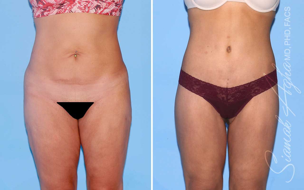 Lower Body Lift Before & After