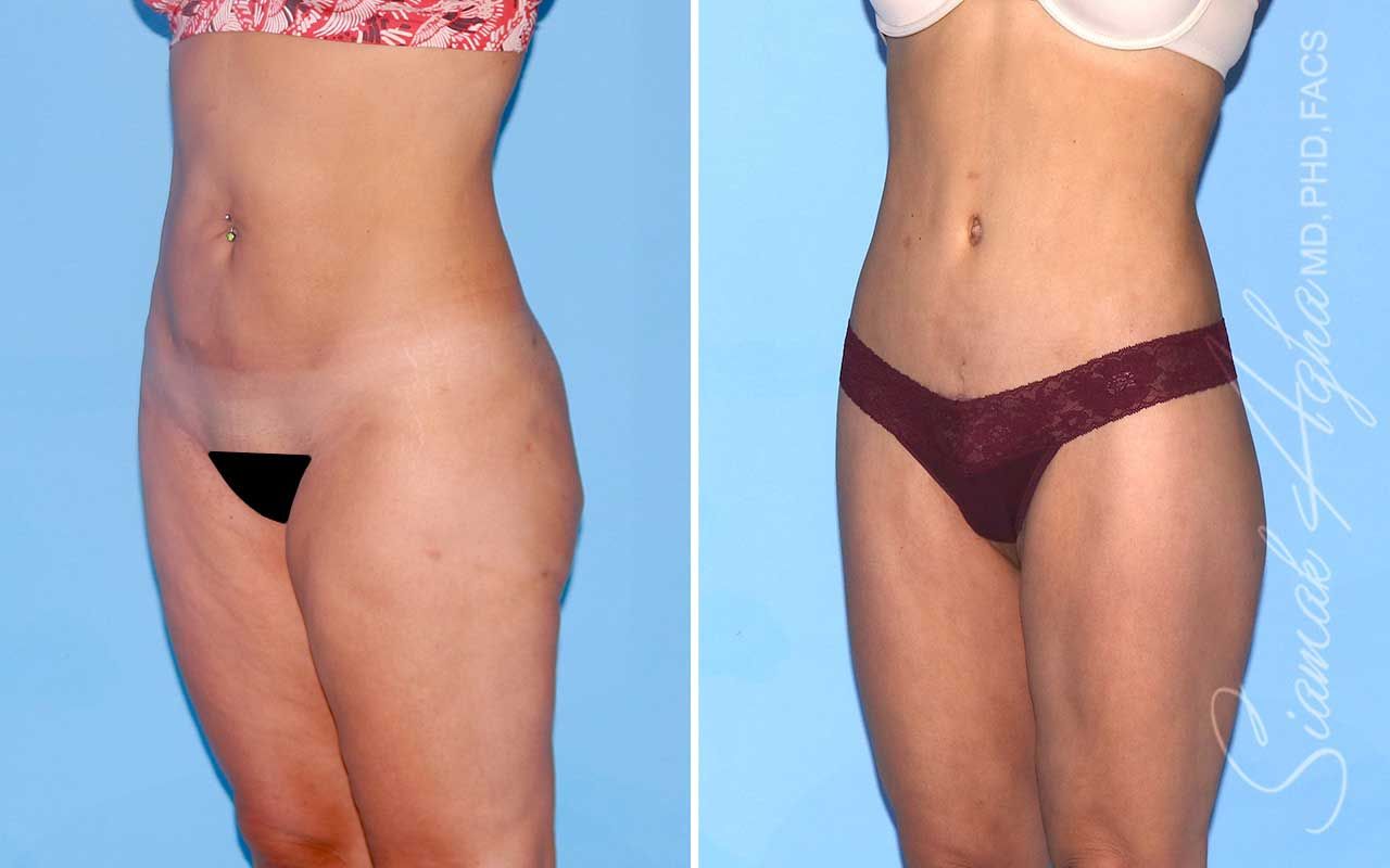 Lower Body Lift Before & After