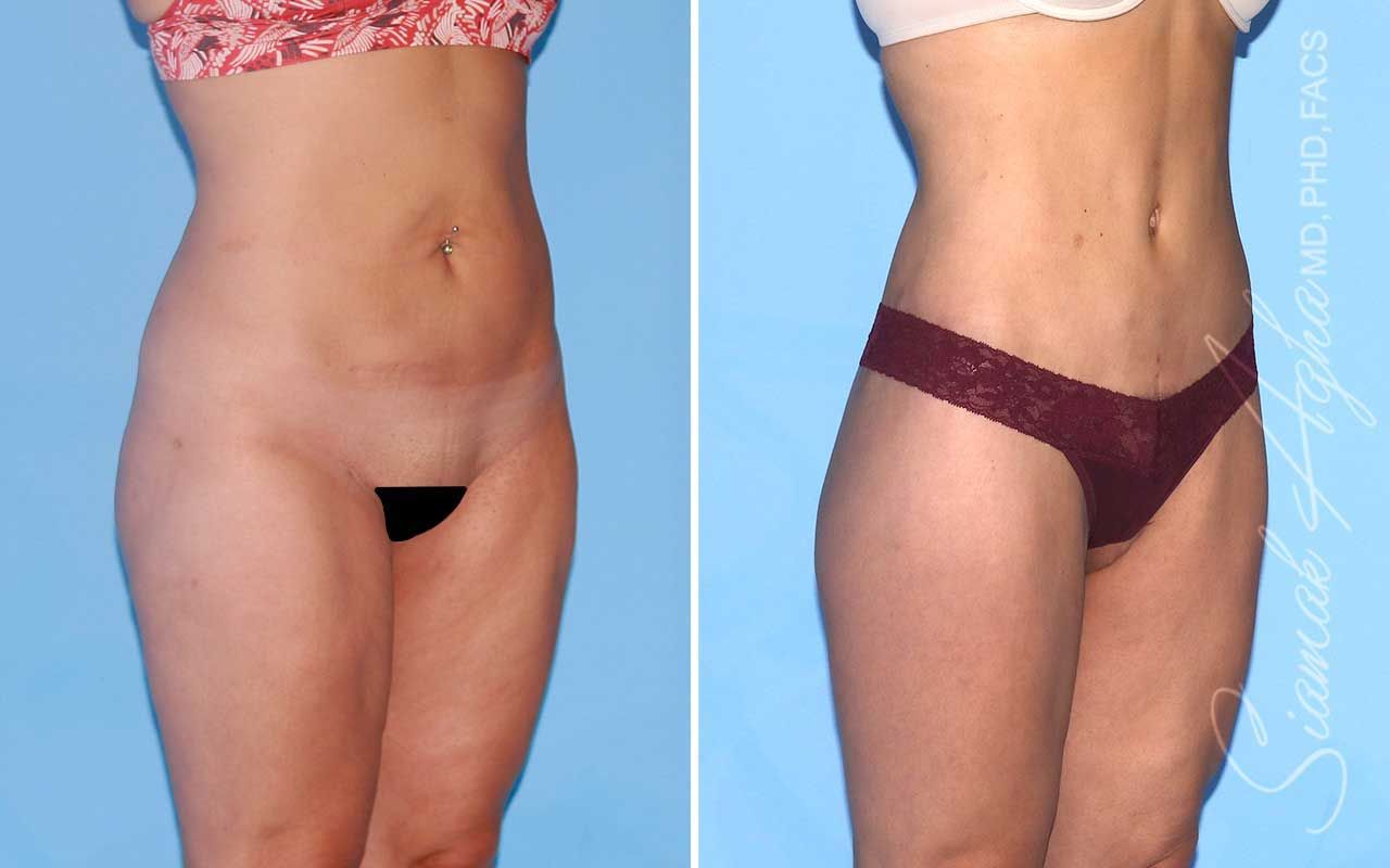 Lower Body Lift Before & After