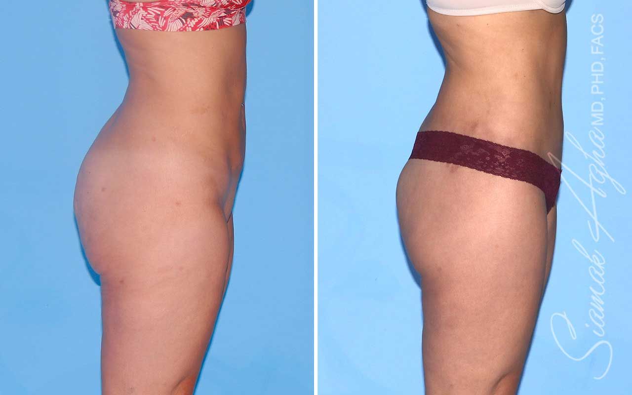 Lower Body Lift Before & After