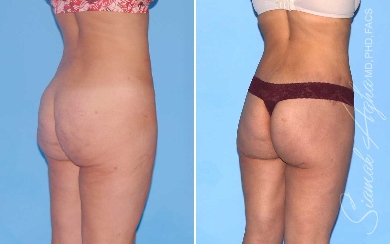 Lower Body Lift Before & After