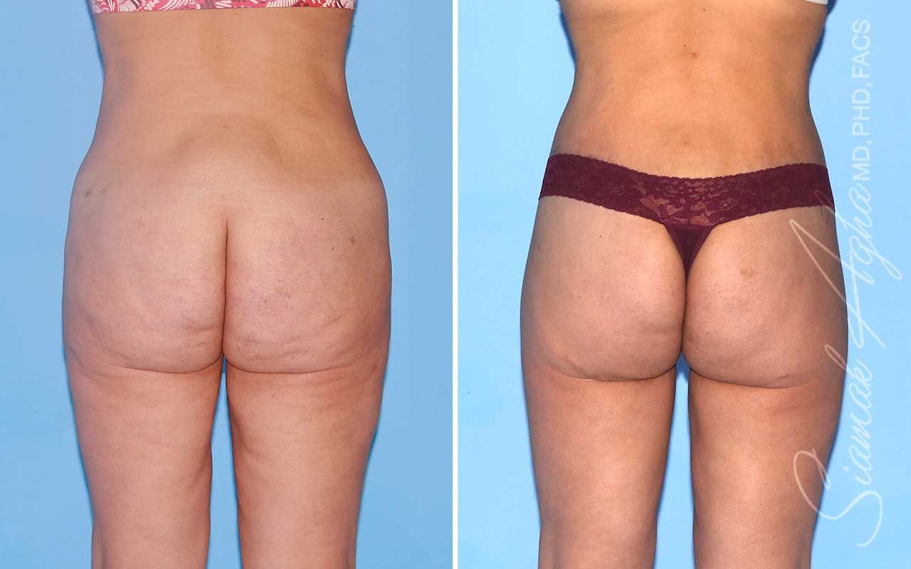 Lower Body Lift Before & After