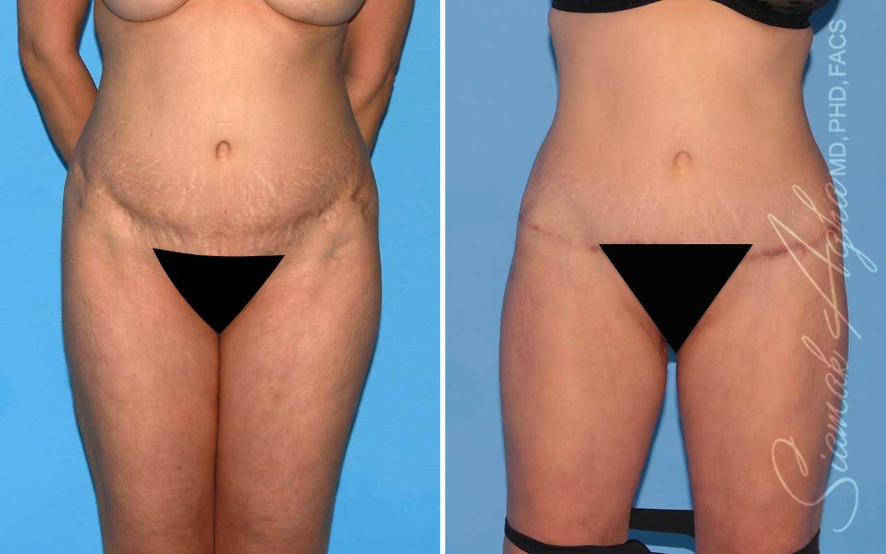 Lower Body Lift Before & After