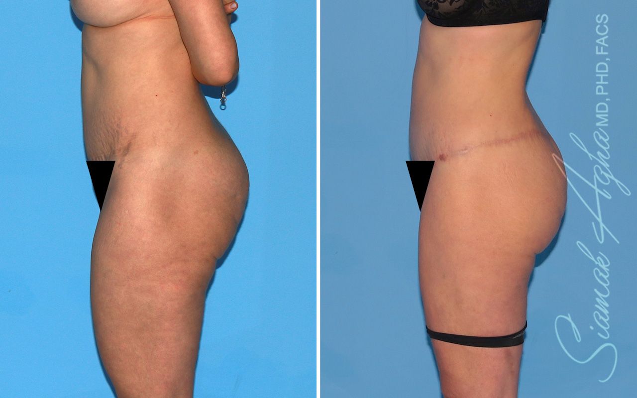 Lower Body Lift Before & After