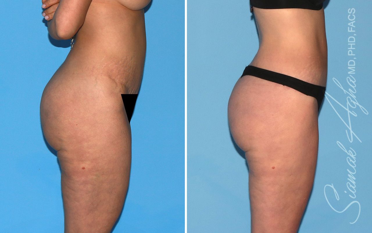 Lower Body Lift Before & After