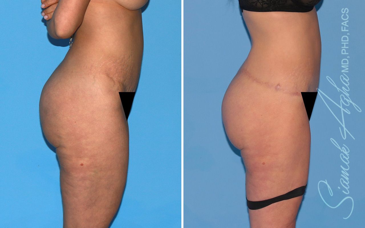 Lower Body Lift Before & After