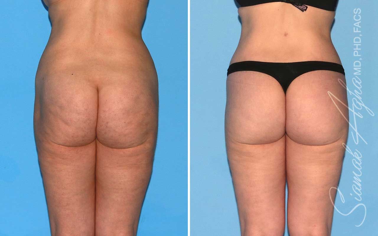 Lower Body Lift Before & After
