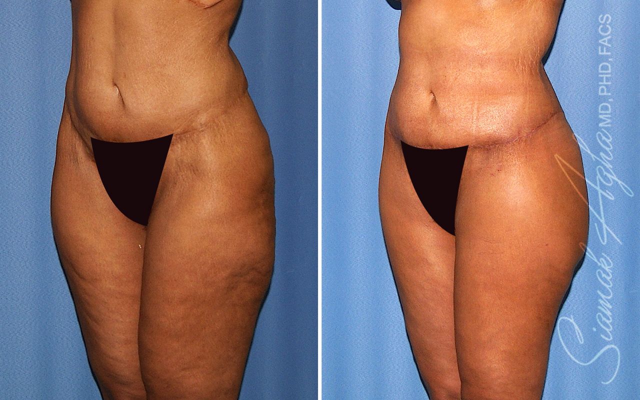 Lower Body Lift Before & After