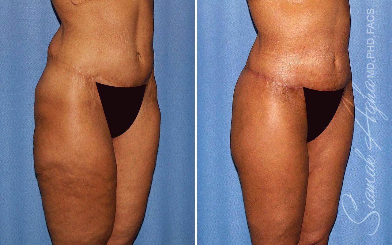 Lower Body Lift Before & After