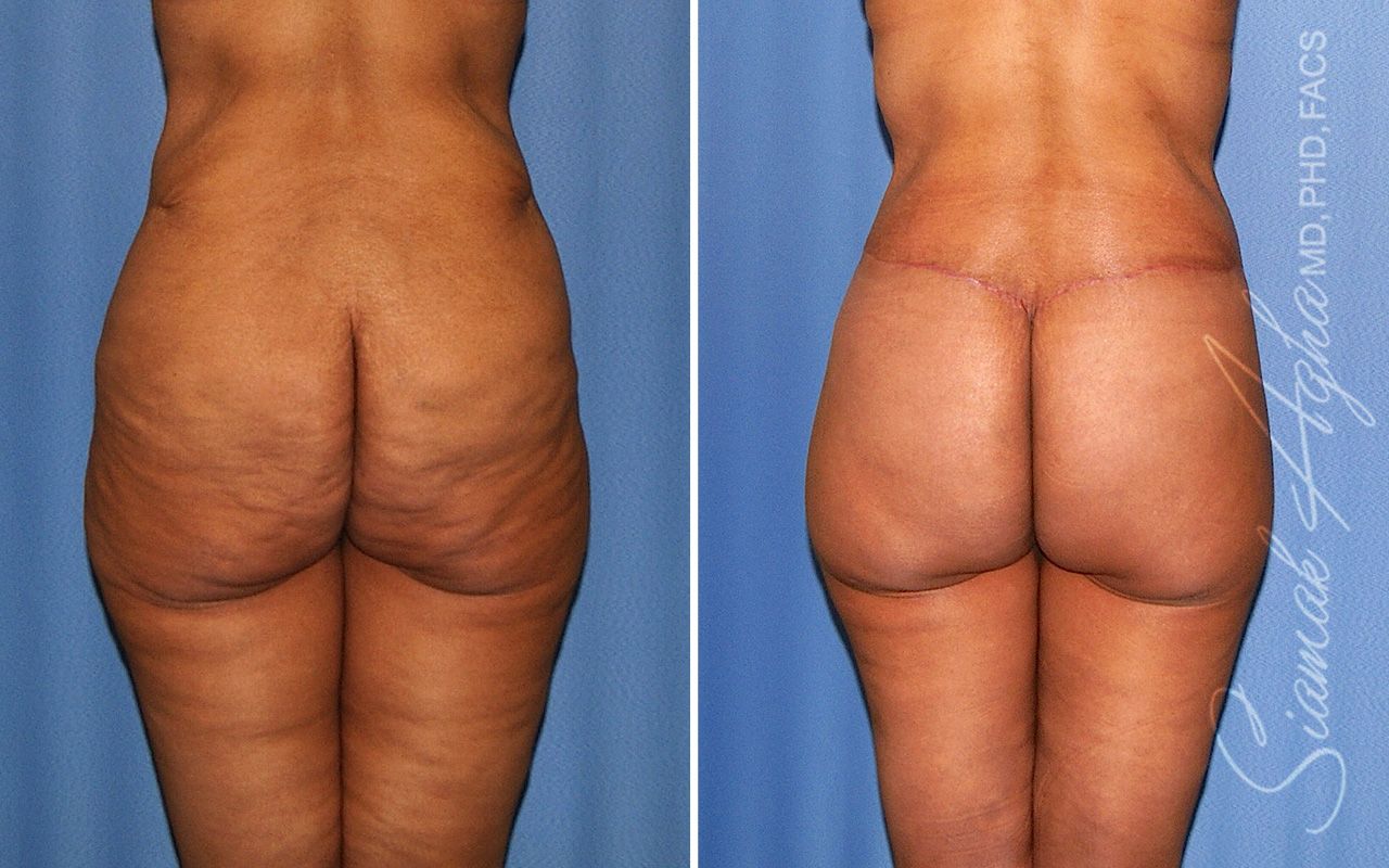Lower Body Lift Before & After