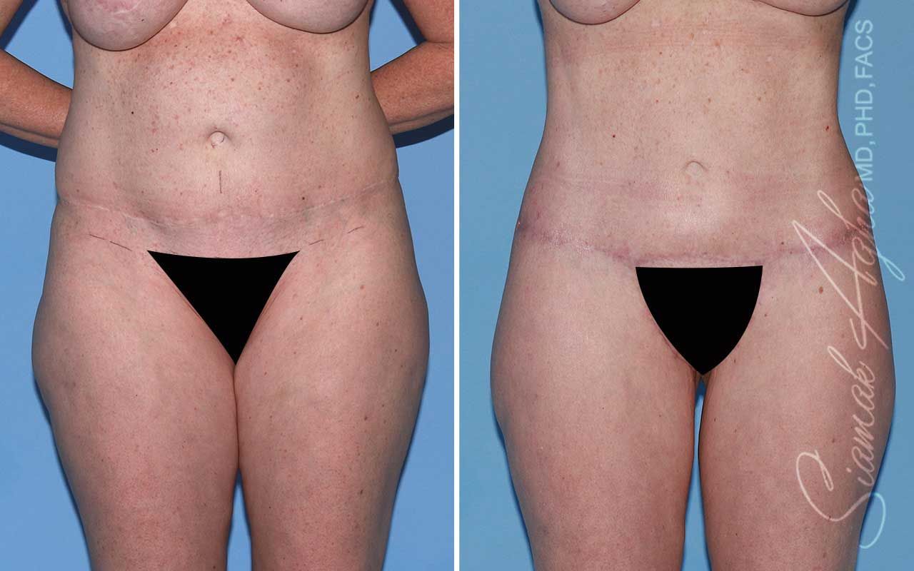 Lower Body Lift Before & After
