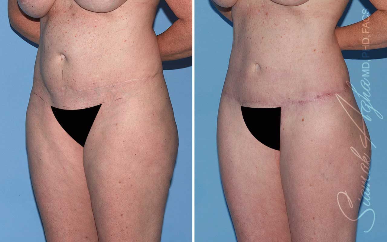 Lower Body Lift Before & After