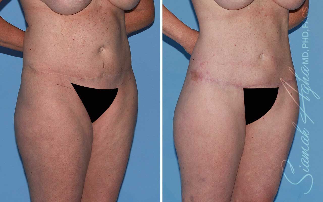 Lower Body Lift Before & After