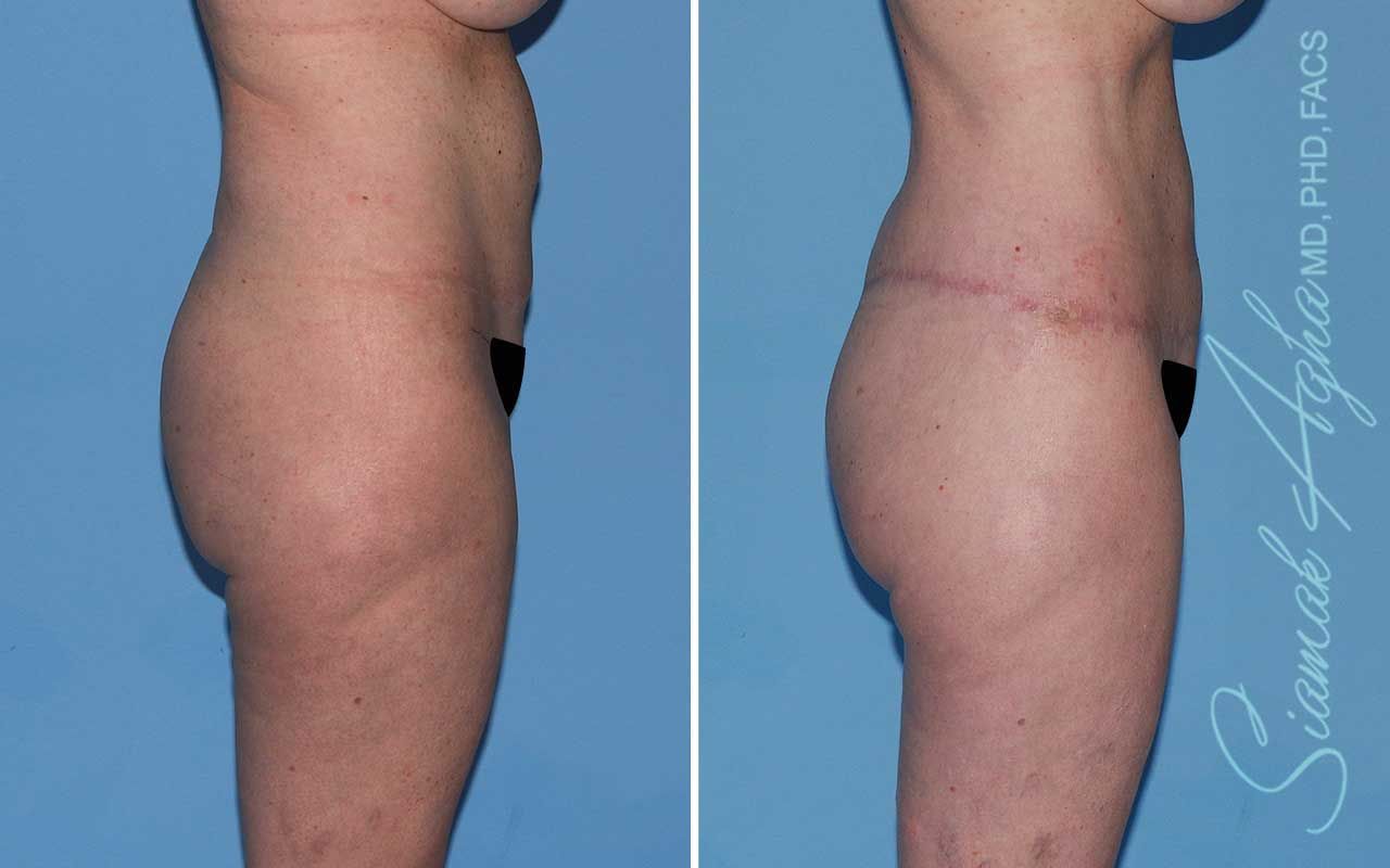 Lower Body Lift Before & After