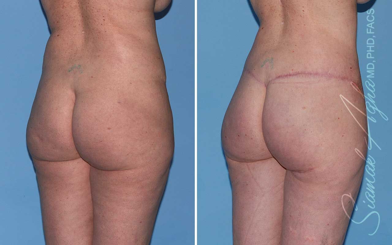 Lower Body Lift Before & After