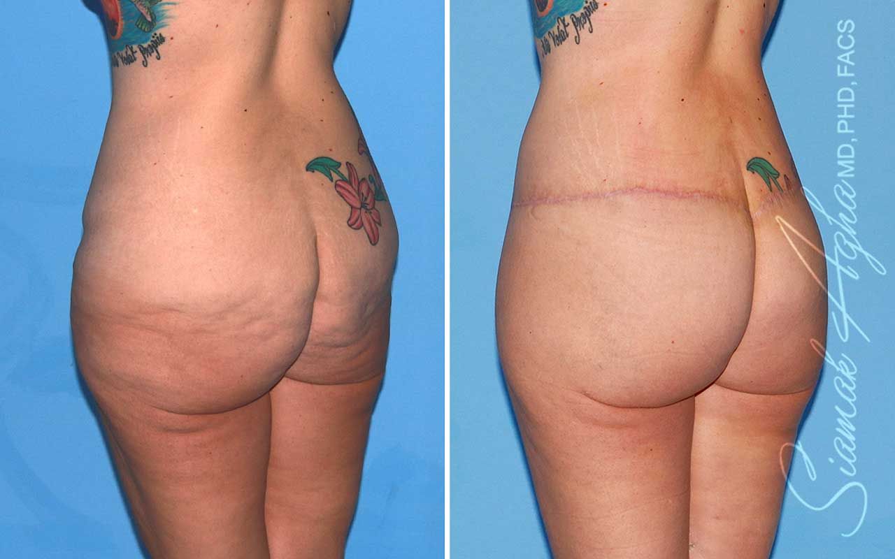 Lower Body Lift Before & After