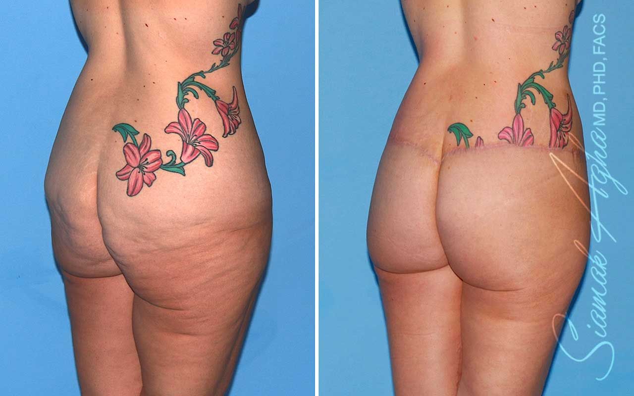 Lower Body Lift Before & After