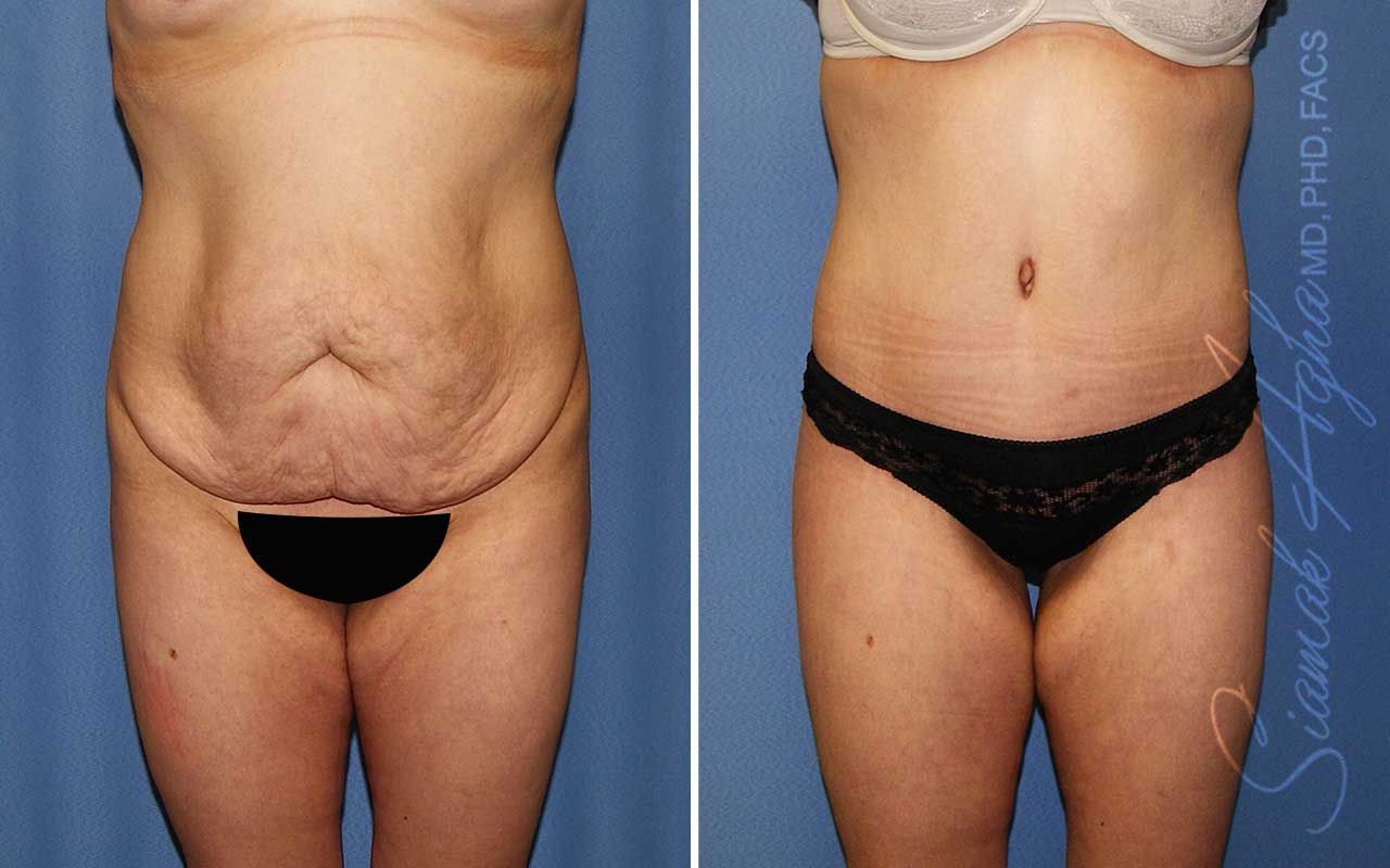 Lower Body Lift Before & After