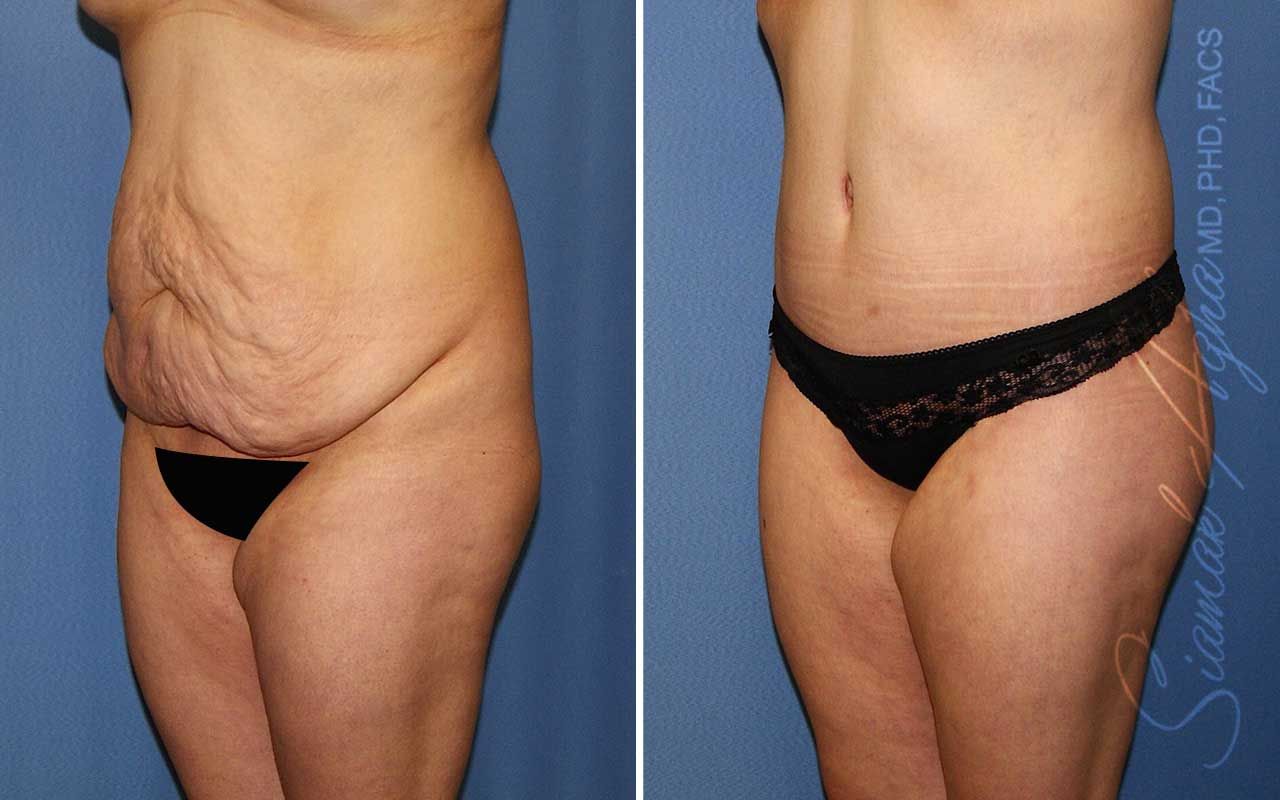 Lower Body Lift Before & After