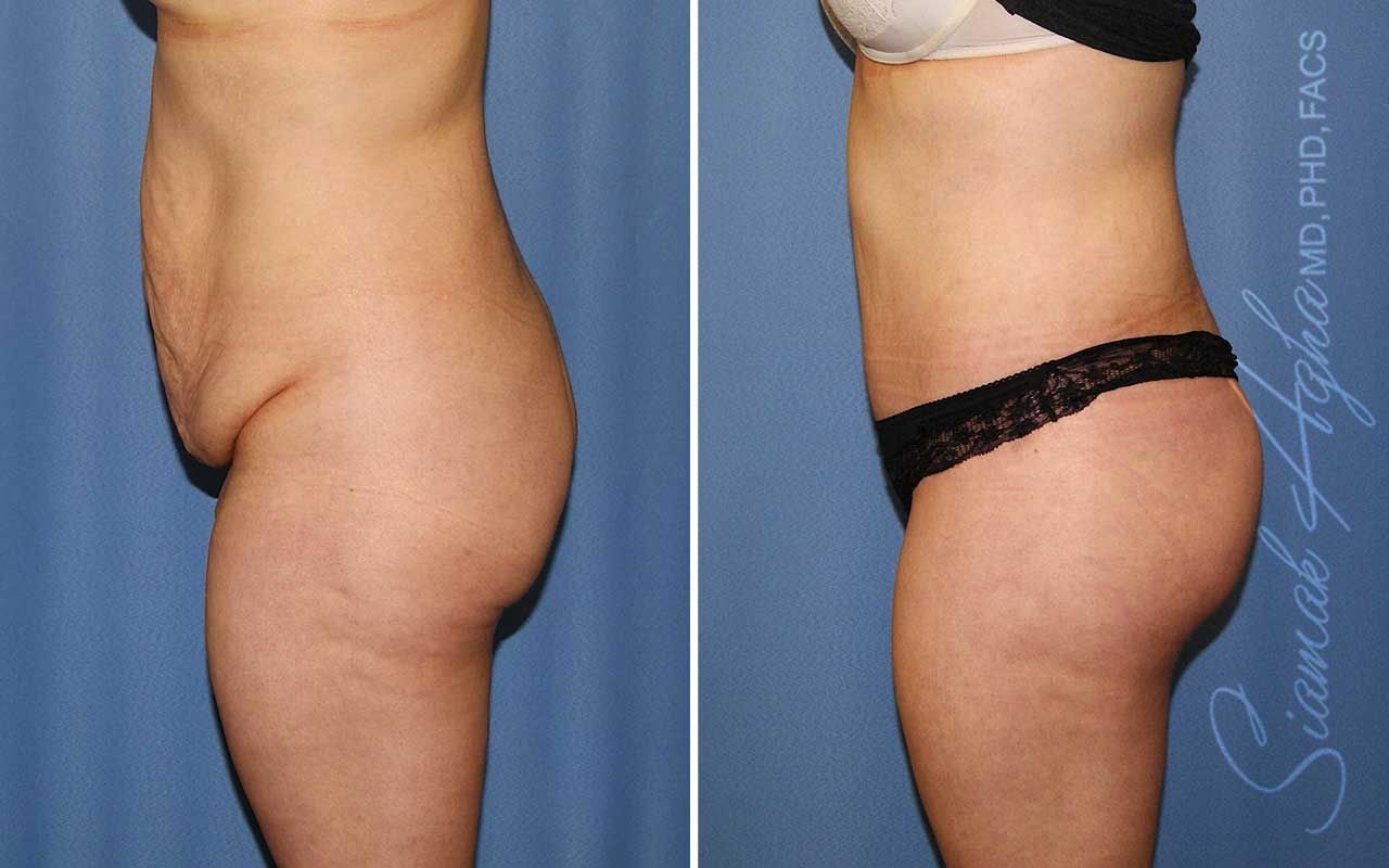 Lower Body Lift Before & After
