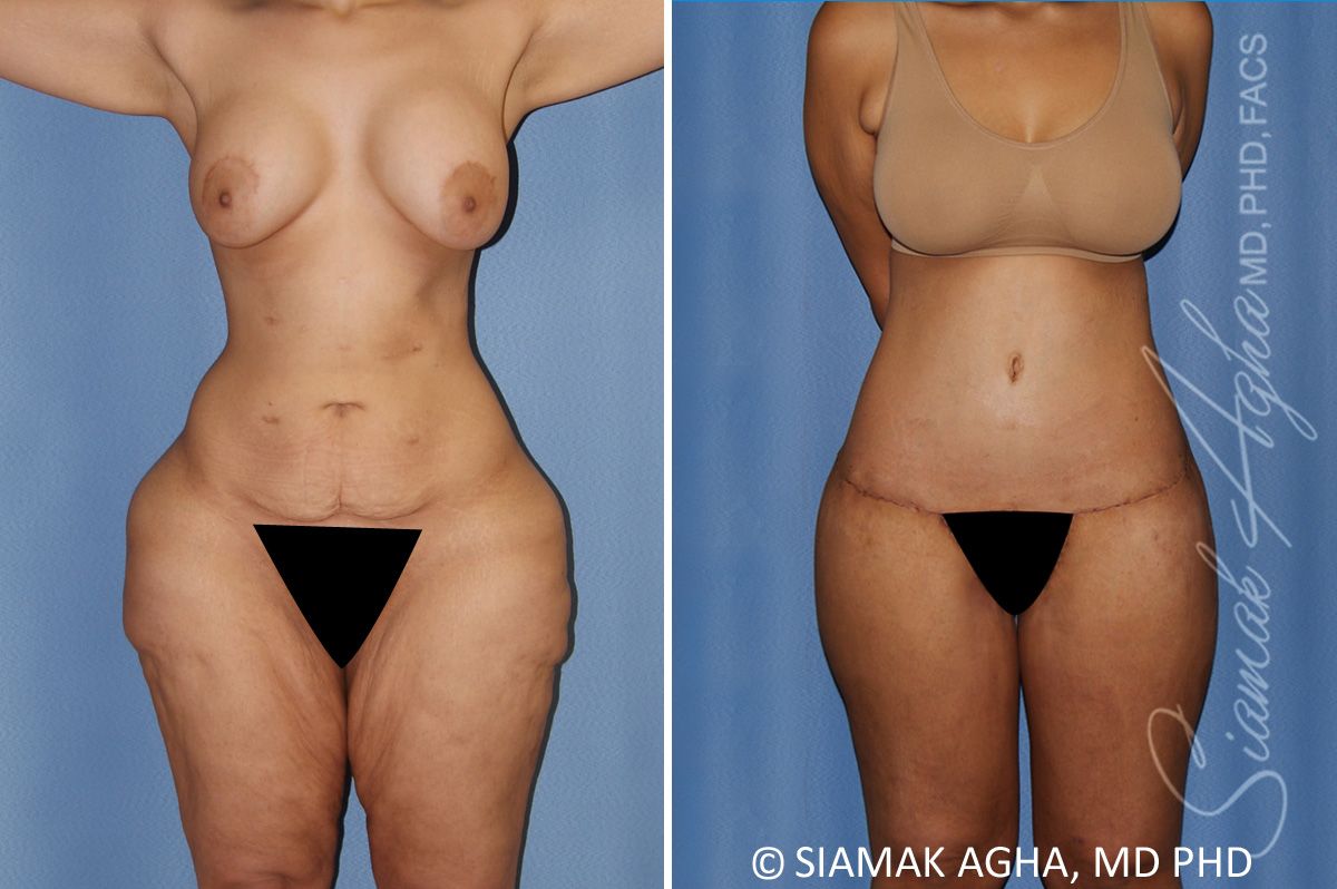 Lower Body Lift Before & After