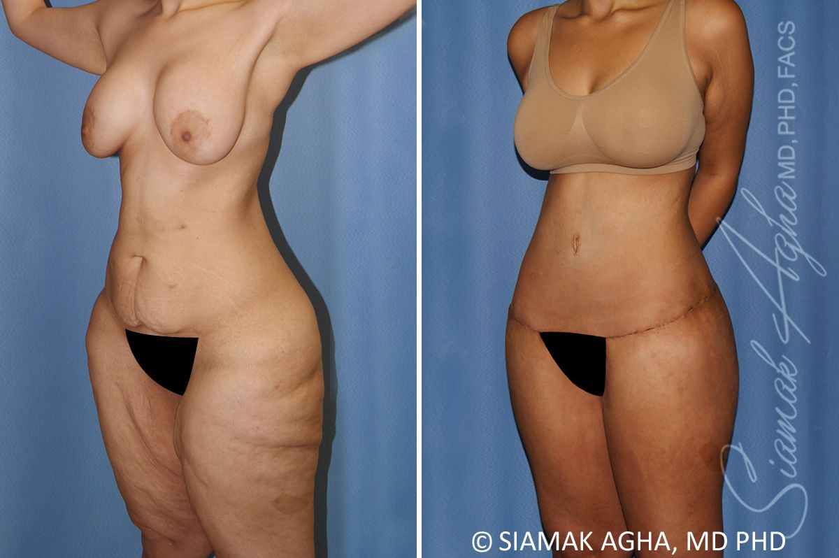 Lower Body Lift Before & After