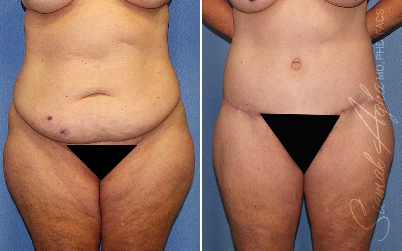 Lower Body Lift Before & After