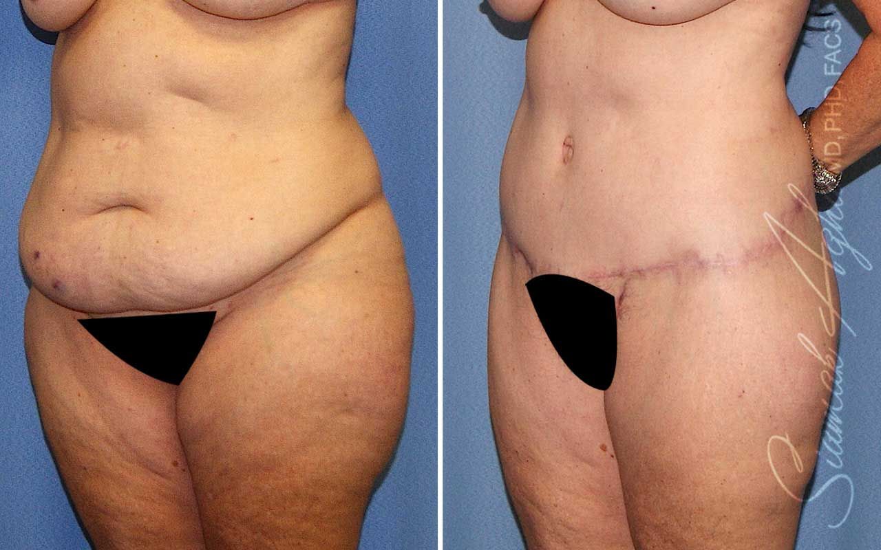 Lower Body Lift Before & After