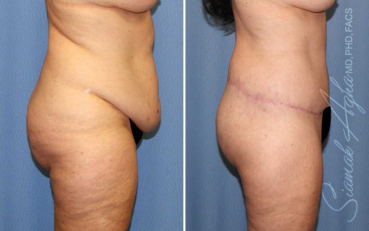 Lower Body Lift Before & After