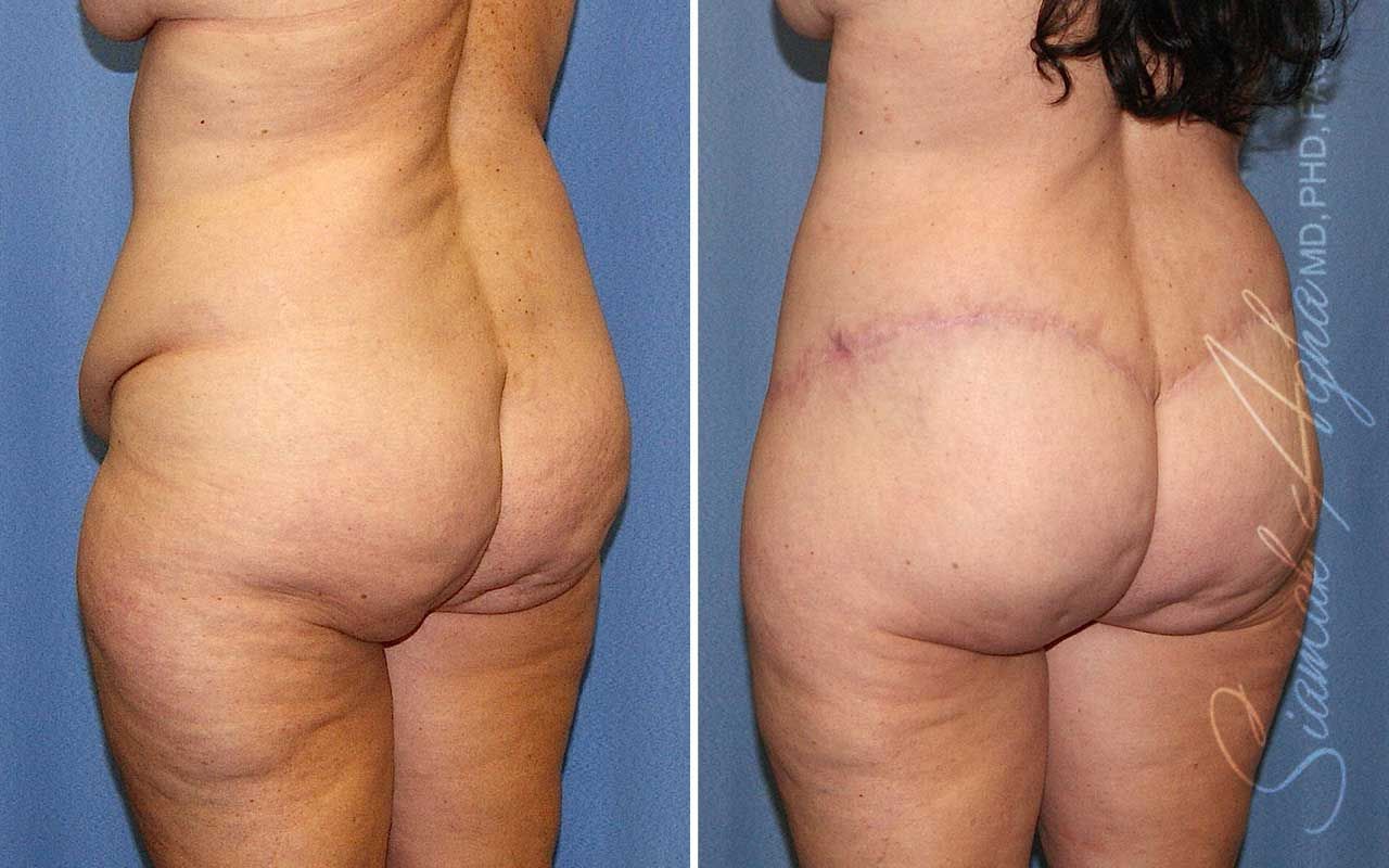 Lower Body Lift Before & After