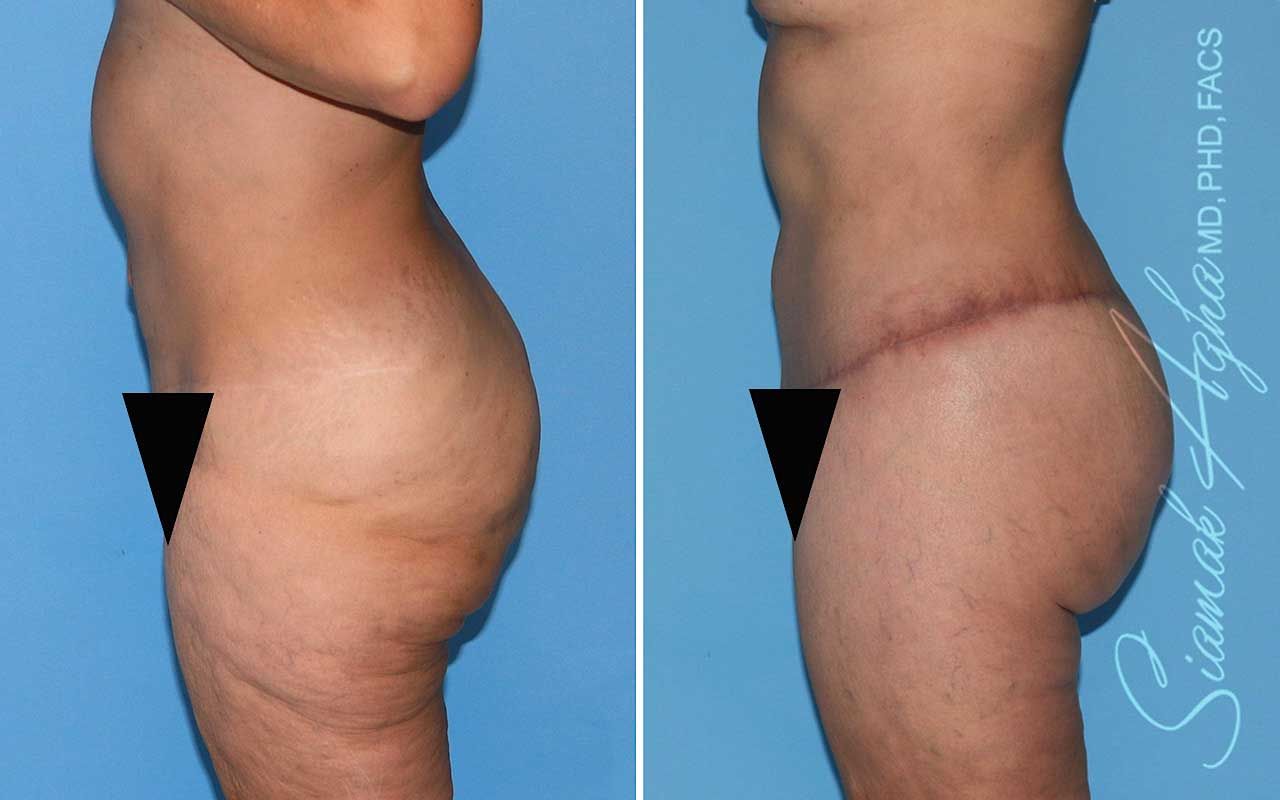 Lower Body Lift Before & After