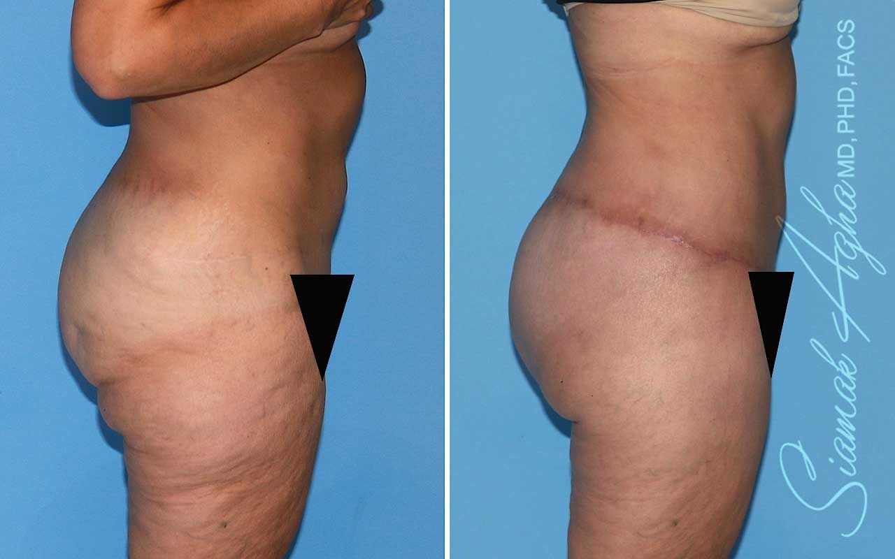 Lower Body Lift Before & After